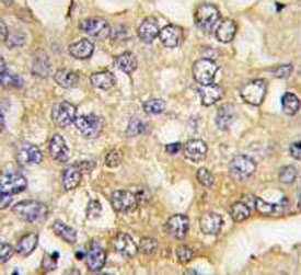 IHC testing of FFPE human hepatocellular carcinoma tissue with PFKM antibody. HIER: steam section in pH6 citrate buffer for 20 min and allow to cool prior to staining.