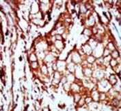 IHC testing of FFPE human breast cancer tissue with YWHAB antibody. HIER: steam section in pH6 citrate buffer for 20 min and allow to cool prior to staining.
