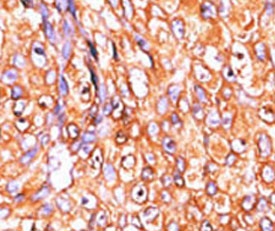 IHC testing of FFPE human breast cancer tissue with Dual specificity protein phosphatase 10 antibody. HIER: steam section in pH6 citrate buffer for 20 min and allow to cool prior to staining.