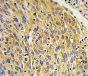 IHC testing of FFPE human lung carcinoma tissue with Phospholipase A2 antibody. HIER: steam section in pH6 citrate buffer for 20 min and allow to cool prior to staining.