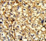 IHC testing of FFPE human breast cancer tissue with Alpha-2B Adrenergic Receptor antibody. HIER: steam section in pH6 citrate buffer for 20 min and allow to cool prior to staining.
