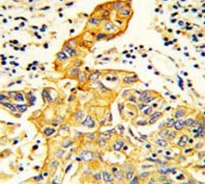 IHC testing of FFPE human lung carcinoma tissue with RARS2 antibody. HIER: steam section in pH6 citrate buffer for 20 min and allow to cool prior to staining.