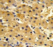 IHC testing of FFPE human hepatocellular carcinoma tissue with HPD antibody. HIER: steam section in pH6 citrate buffer for 20 min and allow to cool prior to staining.