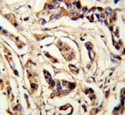 IHC testing of FFPE human breast cancer tissue with TSH beta antibody. HIER: steam section in pH6 citrate buffer for 20 min and allow to cool prior to staining.