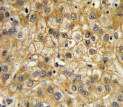 IHC testing of FFPE human hepatocellular carcinoma tissue with Adiponectin receptor 1 antibody. HIER: steam section in pH6 citrate buffer for 20 min and allow to cool prior to staining.