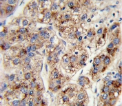 IHC testing of FFPE human hepatocellular carcinoma tissue with EHHADH antibody. HIER: steam section in pH6 citrate buffer for 20 min and allow to cool prior to staining.