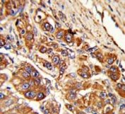 IHC testing of FFPE human hepatocellular carcinoma tissue with Kinesin light chain 1 antibody. HIER: steam section in pH6 citrate buffer for 20 min and allow to cool prior to staining.