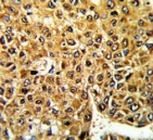 IHC testing of FFPE human hepatocellular carcinoma tissue with Max-like protein X antibody. HIER: steam section in pH6 citrate buffer for 20 min and allow to cool prior to staining.