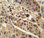 IHC testing of FFPE human hepatocellular carcinoma tissue with KMO antibody. HIER: steam section in pH6 citrate buffer for 20 min and allow to cool prior to staining.