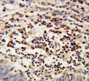IHC testing of FFPE human lung carcinoma tissue with Mitochondrial amidoxime reducing component 2 antibody. HIER: steam section in pH6 citrate buffer for 20 min and allow to cool prior to staining.