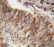 IHC testing of FFPE human lung carcinoma tissue with Aldehyde dehydrogenase family 3 member B1 antibody. HIER: steam section in pH6 citrate buffer for 20 min and allow to cool prior to staining.