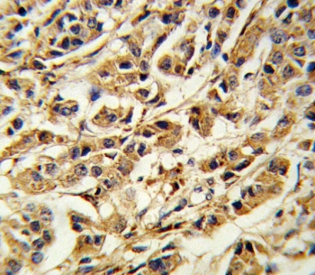 IHC testing of FFPE human breast carcinoma tissue with SREBF1 antibody. HIER: steam section in pH6 citrate buffer for 20 min and allow to cool prior to staining.