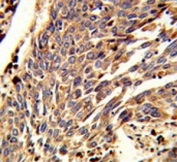 IHC testing of FFPE human lung carcinoma tissue with ARPC1B antibody. HIER: steam section in pH6 citrate buffer for 20 min and allow to cool prior to staining.