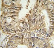 IHC testing of FFPE human colon carcinoma tissue with GPA33 antibody. HIER: steam section in pH6 citrate buffer for 20 min and allow to cool prior to staining.