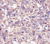 IHC testing of FFPE human hepatocellular carcinoma tissue with Haptoglobin antibody. HIER: steam section in pH6 citrate buffer for 20 min and allow to cool prior to staining.