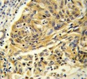 IHC testing of FFPE human lung carcinoma tissue with Clathrin Light Chain A antibody. HIER: steam section in pH6 citrate buffer for 20 min and allow to cool prior to staining.