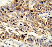 IHC testing of FFPE human lung carcinoma tissue with EFEMP1 antibody. HIER: steam section in pH6 citrate buffer for 20 min and allow to cool prior to staining.