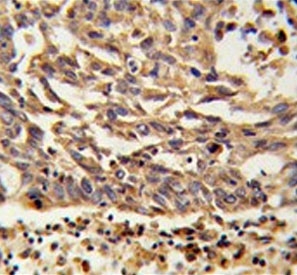 IHC testing of FFPE human lung carcinoma tissue with KIF11 antibody. HIER: steam section in pH6 citrate buffer for 20 min and allow to cool prior to staining.