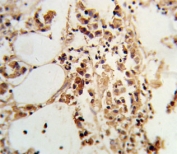IHC testing of FFPE human breast carcinoma tissue with TIMP3 antibody. HIER: steam section in pH6 citrate buffer for 20 min and allow to cool prior to staining.