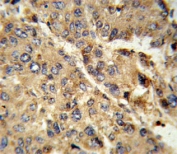 IHC testing of FFPE human hepatocellular carcinoma tissue with XDH antibody. HIER: steam section in pH6 citrate buffer for 20 min and allow to cool prior to staining.