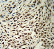 IHC testing of FFPE human lung carcinoma tissue with Sm-D3 antibody. HIER: steam section in pH6 citrate buffer for 20 min and allow to cool prior to staining.