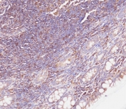 IHC testing of FFPE human colon carcinoma tissue with Beta Glucuronidase antibody. HIER: steam section in pH9 EDTA buffer for 20 min and allow to cool prior to staining.