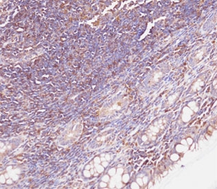 IHC testing of FFPE human colon carcinoma tissue with Beta Glucuronidase antibody. HIER: steam section in pH9 EDTA buffer for 20 min and allow to cool prior to staining.