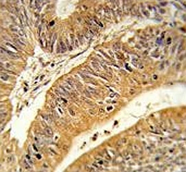 IHC testing of FFPE human colon carcinoma tissue with CXXC4 antibody. HIER: steam section in pH6 citrate buffer for 20 min and allow to cool prior to staining.
