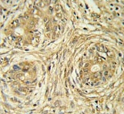 IHC testing of FFPE human prostate cancer tissue with SUPV3L1 antibody. HIER: steam section in pH6 citrate buffer for 20 min and allow to cool prior to staining.