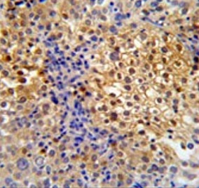 IHC testing of FFPE human cervical carcinoma tissue with PRPF38A antibody. HIER: steam section in pH6 citrate buffer for 20 min and allow to cool prior to staining.