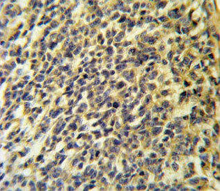 IHC testing of FFPE human testis carcinoma tissue with CaI-PLA2 antibody. HIER: steam section in pH6 citrate buffer for 20 min and allow to cool prior to staining.