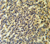 IHC testing of FFPE human testis carcinoma tissue with CaI-PLA2 antibody. HIER: steam section in pH6 citrate buffer for 20 min and allow to cool prior to staining.