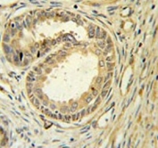 IHC testing of FFPE human prostate carcinoma tissue with Speedy protein A antibody. HIER: steam section in pH6 citrate buffer for 20 min and allow to cool prior to staining.