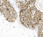 IHC staining of FFPE human esophageal squamous carcinoma tissue with PD-L1 antibody. HIER: steam section in pH9 EDTA buffer for 20 min and allow to cool prior to staining.