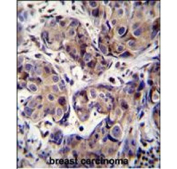 IHC staining of FFPE human breast cancer tissue with MAGE3 antibody. HIER: steam section in pH6 citrate buffer for 20 min and allow to cool prior to staining.