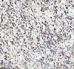 IHC analysis of GINS4 using anti-GINS4 antibody. GINS4 was detected in a paraffin-embedded section of human melanoma tissue. Heat mediated antigen retrieval was performed in EDTA buffer (pH 8.0, epitope retrieval solution). The tissue section was blocked with 10% goat serum. The tissue section was then incubated with 2 ug/ml rabbit anti-GINS4 antibody overnight at 4oC. Peroxidase Conjugated Goat Anti-rabbit IgG was used as secondary antibody and incubated for 30 minutes at 37oC. The tissue section was developed using an HRP secondary and DAB substrate.
