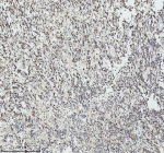 IHC analysis of GINS4 using anti-GINS4 antibody. GINS4 was detected in a paraffin-embedded section of human melanoma tissue. Heat mediated antigen retrieval was performed in EDTA buffer (pH 8.0, epitope retrieval solution). The tissue section was blocked with 10% goat serum. The tissue section was then incubated with 2 ug/ml rabbit anti-GINS4 antibody overnight at 4oC. Peroxidase Conjugated Goat Anti-rabbit IgG was used as secondary antibody and incubated for 30 minutes at 37oC. The tissue section was developed using an HRP secondary and DAB substrate.