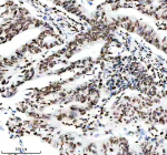 IHC analysis of Histone H3 (acetyl K14) using anti-Histone H3 (acetyl K14) antibody. Histone H3 (acetyl K14) was detected in a paraffin-embedded section of human rectal cancer tissue. Heat mediated antigen retrieval was performed in EDTA buffer (pH 8.0, epitope retrieval solution). The tissue section was blocked with 10% goat serum. The tissue section was then incubated with a dilution of 1:50 rabbit anti-Histone H3 (acetyl K14) antibody overnight at 4oC. Peroxidase Conjugated Goat Anti-rabbit IgG was used as secondary antibody and incubated for 30 minutes at 37oC. The tissue section was developed using an HRP secondary and DAB substrate.