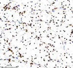 IHC analysis of Histone H3 (acetyl K14) using anti-Histone H3 (acetyl K14) antibody. Histone H3 (acetyl K14) was detected in a paraffin-embedded section of human clear cell renal cell carcinoma tissue. Heat mediated antigen retrieval was performed in EDTA buffer (pH 8.0, epitope retrieval solution). The tissue section was blocked with 10% goat serum. The tissue section was then incubated with a dilution of 1:50 rabbit anti-Histone H3 (acetyl K14) antibody overnight at 4oC. Peroxidase Conjugated Goat Anti-rabbit IgG was used as secondary antibody and incubated for 30 minutes at 37oC. The tissue section was developed using an HRP secondary and DAB substrate.