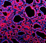 IF analysis of TMED10 using anti-TMED10 antibody (red). TMED10 was detected in a paraffin-embedded section of human thyroid cancer tissue. Heat mediated antigen retrieval was performed in EDTA buffer (pH 8.0, epitope retrieval solution). The tissue section was blocked with 10% goat serum. The tissue section was then incubated with 5 ug/ml rabbit anti-TMED10 antibody overnight at 4oC. Cy3 Conjugated Goat Anti-Rabbit IgG was used as secondary antibody at 1:500 dilution and incubated for 30 minutes at 37oC. The section was counterstained with DAPI (blue). Visualize using a fluorescence microscope and filter sets appropriate for the label used.