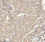 IHC analysis of NDUFA9 using anti-NDUFA9 antibody. NDUFA9 was detected in a paraffin-embedded section of human breast cancer tissue. Heat mediated antigen retrieval was performed in EDTA buffer (pH 8.0, epitope retrieval solution). The tissue section was blocked with 10% goat serum. The tissue section was then incubated with 2 ug/ml rabbit anti-NDUFA9 antibody overnight at 4oC. Peroxidase Conjugated Goat Anti-rabbit IgG was used as secondary antibody and incubated for 30 minutes at 37oC. The tissue section was developed using an HRP secondary and DAB substrate.