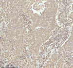 IHC analysis of NDUFA9 using anti-NDUFA9 antibody. NDUFA9 was detected in a paraffin-embedded section of human breast cancer tissue. Heat mediated antigen retrieval was performed in EDTA buffer (pH 8.0, epitope retrieval solution). The tissue section was blocked with 10% goat serum. The tissue section was then incubated with 2 ug/ml rabbit anti-NDUFA9 antibody overnight at 4oC. Peroxidase Conjugated Goat Anti-rabbit IgG was used as secondary antibody and incubated for 30 minutes at 37oC. The tissue section was developed using an HRP secondary and DAB substrate.