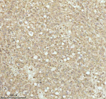 IHC analysis of NDUFA9 using anti-NDUFA9 antibody. NDUFA9 was detected in a paraffin-embedded section of human liver cancer tissue. Heat mediated antigen retrieval was performed in EDTA buffer (pH 8.0, epitope retrieval solution). The tissue section was blocked with 10% goat serum. The tissue section was then incubated with 2 ug/ml rabbit anti-NDUFA9 antibody overnight at 4oC. Peroxidase Conjugated Goat Anti-rabbit IgG was used as secondary antibody and incubated for 30 minutes at 37oC. The tissue section was developed using an HRP secondary and DAB substrate.