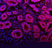 Immunofluorescent staining of FFPE human breast cancer tissue with NDUFA9 antibody (red) and DAPI nuclear stain (blue). HIER: steam section in pH8 EDTA buffer for 20 min.