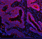 Immunofluorescent staining of FFPE human colon cancer tissue with NDUFA9 antibody (red) and DAPI nuclear stain (blue). HIER: steam section in pH8 EDTA buffer for 20 min.