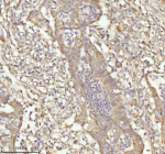 IHC analysis of NDUFA9 using anti-NDUFA9 antibody. NDUFA9 was detected in a paraffin-embedded section of human rectum adenocarcinoma tissue. Heat mediated antigen retrieval was performed in EDTA buffer (pH 8.0, epitope retrieval solution). The tissue section was blocked with 10% goat serum. The tissue section was then incubated with 2 ug/ml rabbit anti-NDUFA9 antibody overnight at 4oC. Peroxidase Conjugated Goat Anti-rabbit IgG was used as secondary antibody and incubated for 30 minutes at 37oC. The tissue section was developed using an HRP secondary and DAB substrate.