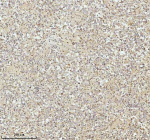 IHC analysis of NDUFA9 using anti-NDUFA9 antibody. NDUFA9 was detected in a paraffin-embedded section of human testicular seminoma tissue. Heat mediated antigen retrieval was performed in EDTA buffer (pH 8.0, epitope retrieval solution). The tissue section was blocked with 10% goat serum. The tissue section was then incubated with 2 ug/ml rabbit anti-NDUFA9 antibody overnight at 4oC. Peroxidase Conjugated Goat Anti-rabbit IgG was used as secondary antibody and incubated for 30 minutes at 37oC. The tissue section was developed using an HRP secondary and DAB substrate.