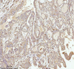 IHC analysis of NDUFA9 using anti-NDUFA9 antibody. NDUFA9 was detected in a paraffin-embedded section of human thyroid papillary carcinoma tissue. Heat mediated antigen retrieval was performed in EDTA buffer (pH 8.0, epitope retrieval solution). The tissue section was blocked with 10% goat serum. The tissue section was then incubated with 2 ug/ml rabbit anti-NDUFA9 antibody overnight at 4oC. Peroxidase Conjugated Goat Anti-rabbit IgG was used as secondary antibody and incubated for 30 minutes at 37oC. The tissue section was developed using an HRP secondary and DAB substrate.