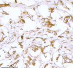 IHC analysis of STC2 using anti-STC2 antibody. STC2 was detected in a paraffin-embedded section of human breast cancer tissue. Heat mediated antigen retrieval was performed in EDTA buffer (pH 8.0, epitope retrieval solution). The tissue section was blocked with 10% goat serum. The tissue section was then incubated with 2 ug/ml rabbit anti-STC2 antibody overnight at 4oC. Peroxidase Conjugated Goat Anti-rabbit IgG was used as secondary antibody and incubated for 30 minutes at 37oC. The tissue section was developed using an HRP secondary and DAB substrate.