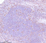 IHC analysis of STC2 using anti-STC2 antibody. STC2 was detected in a paraffin-embedded section of human lung squamous cell carcinoma tissue. Heat mediated antigen retrieval was performed in EDTA buffer (pH 8.0, epitope retrieval solution). The tissue section was blocked with 10% goat serum. The tissue section was then incubated with 2 ug/ml rabbit anti-STC2 antibody overnight at 4oC. Peroxidase Conjugated Goat Anti-rabbit IgG was used as secondary antibody and incubated for 30 minutes at 37oC. The tissue section was developed using an HRP secondary and DAB substrate.
